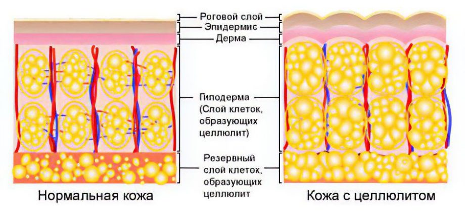 Cellulite on thighs and buttocks