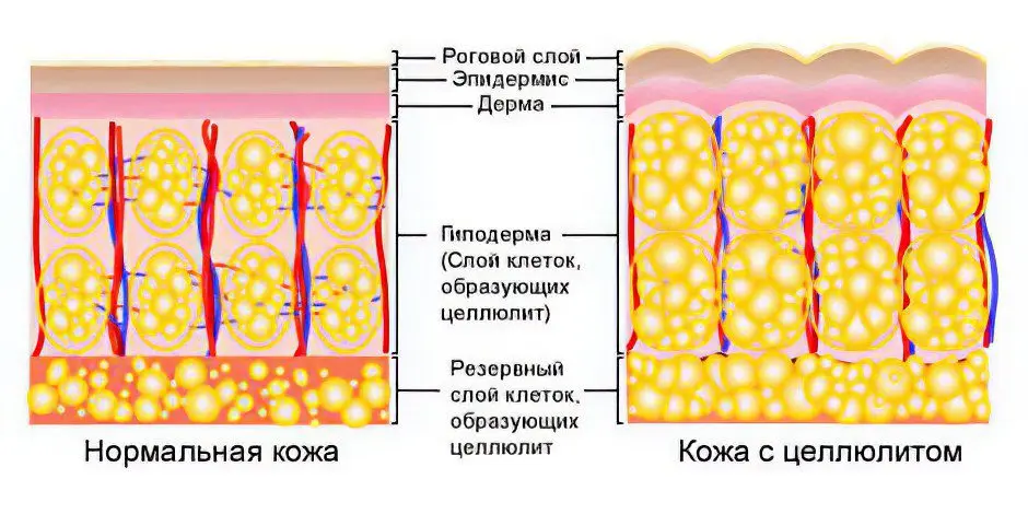 Cellulite on thighs and buttocks