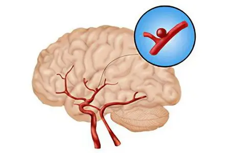 Cerebral aneurysm