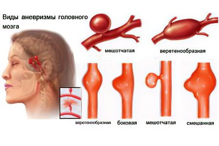 Cerebral aneurysm