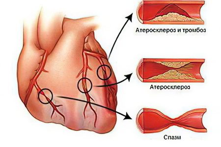 Cerebral ischemia in newborns