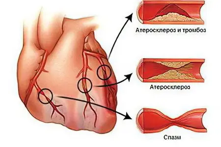 Cerebral ischemia in newborns