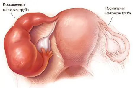 Cervical erosion: causes, symptoms and treatment