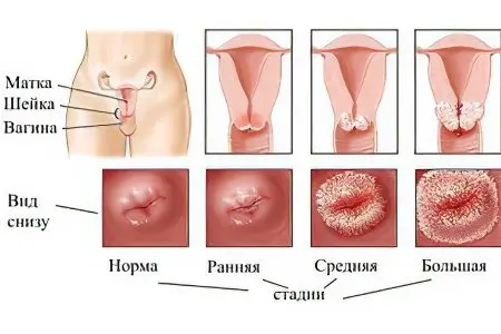 Cervical erosion: causes, symptoms and treatment