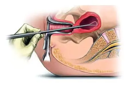 Cervical erosion: causes, symptoms and treatment