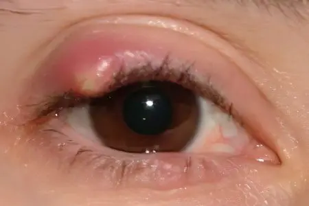 Chalazion: causes, symptoms, types, diagnosis, treatment