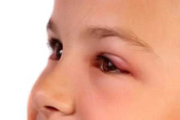 Chalazion on the eye in children (child)