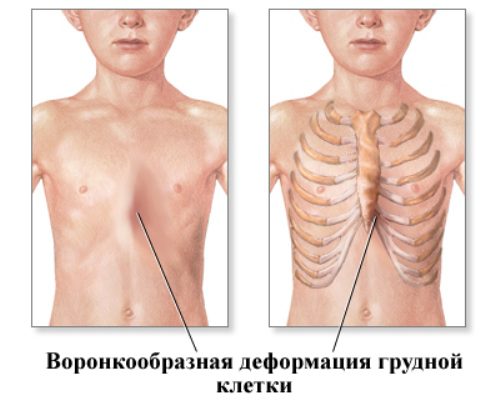 Chest deformity