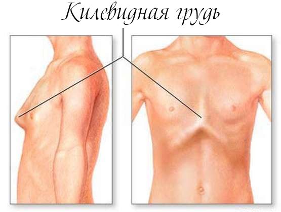 Chest deformity