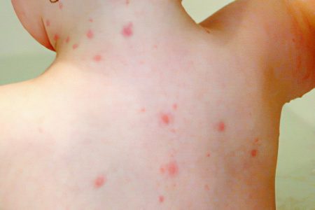 Chickenpox: symptoms and treatment