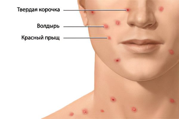 Chickenpox: symptoms and treatment