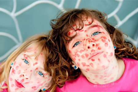 Chickenpox: symptoms and treatment