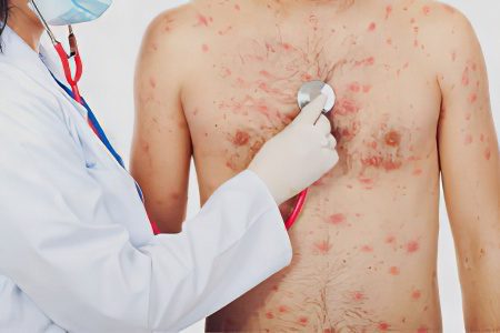 Chickenpox: symptoms and treatment