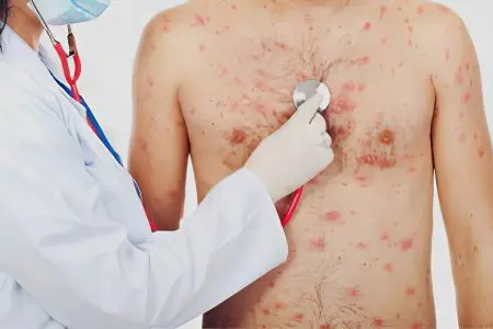 Chickenpox: symptoms and treatment