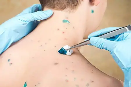 Chickenpox: symptoms and treatment