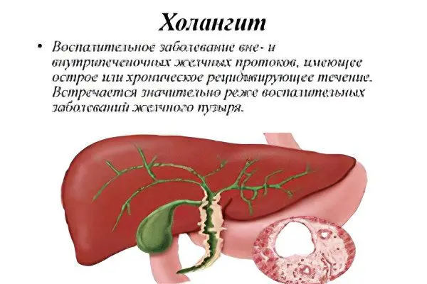 Cholangitis: symptoms and treatment