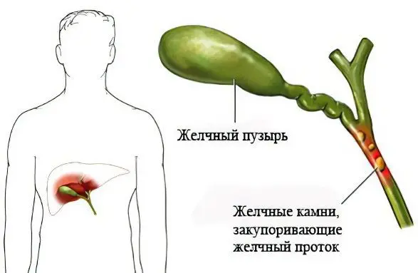 Cholecystitis: types, symptoms, treatment