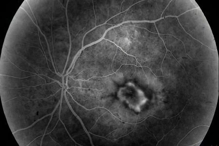 Chorioretinal retinal dystrophy