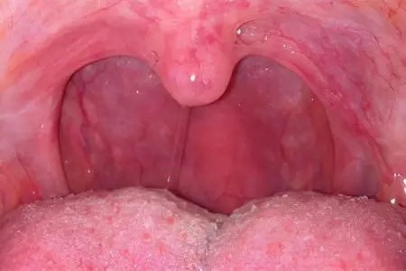 Chronic pharyngitis