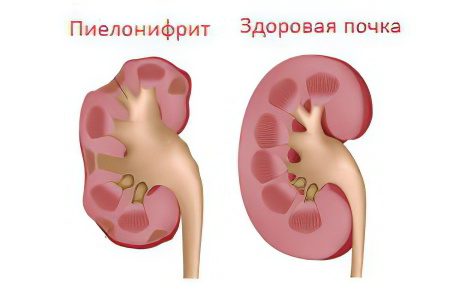 Chronic pyelonephritis