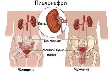 Chronic pyelonephritis