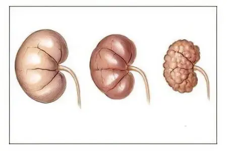 Chronic renal failure