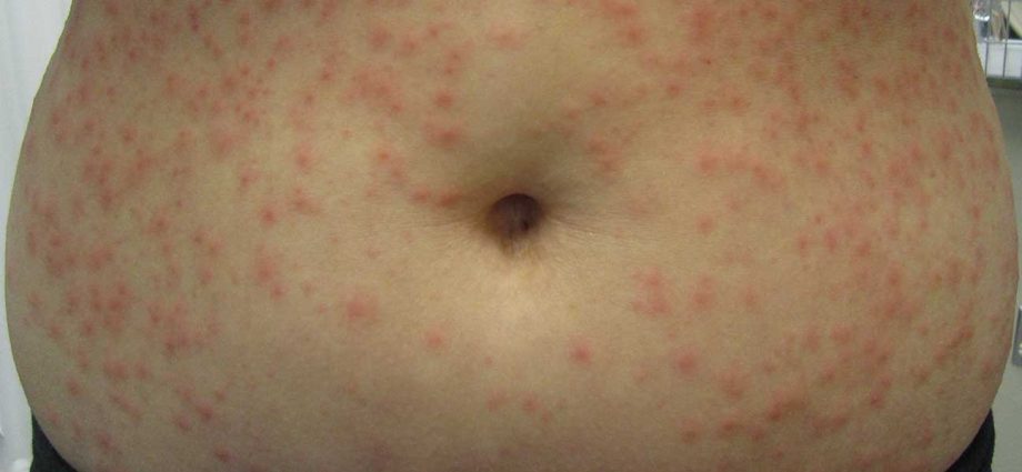 Colliculitis &#8211; Symptoms, Diagnosis and Treatment