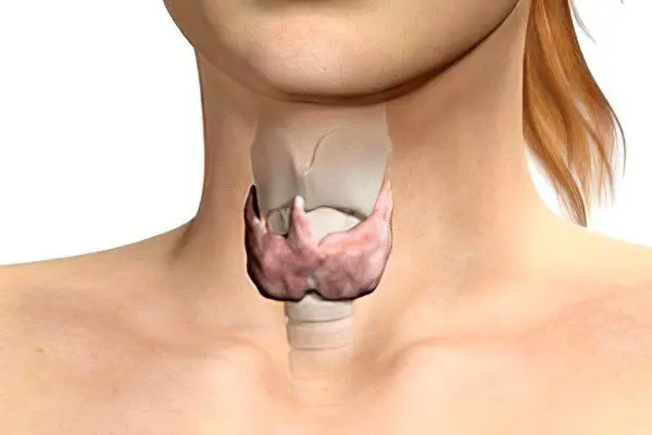 Colloidal goiter of the thyroid gland