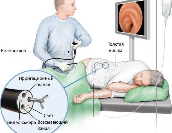 Colonoscopy of the intestine