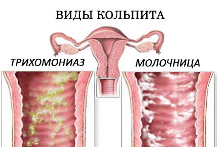 Colpitis in women - what is it, what are the symptoms, how to treat?