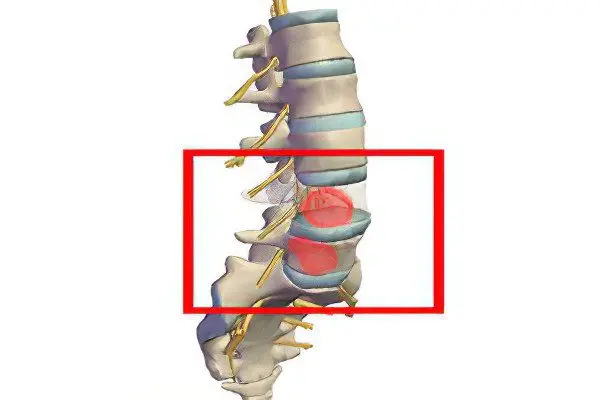 Compression fracture of the lumbar spine