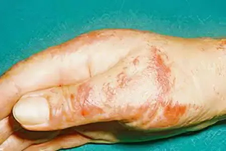 Contact dermatitis