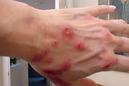 Contact dermatitis