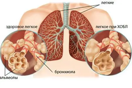 COPD: causes, symptoms, stages, treatment