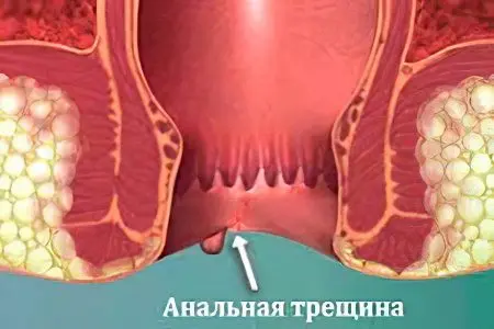 Cracks in the anus: symptoms and treatment