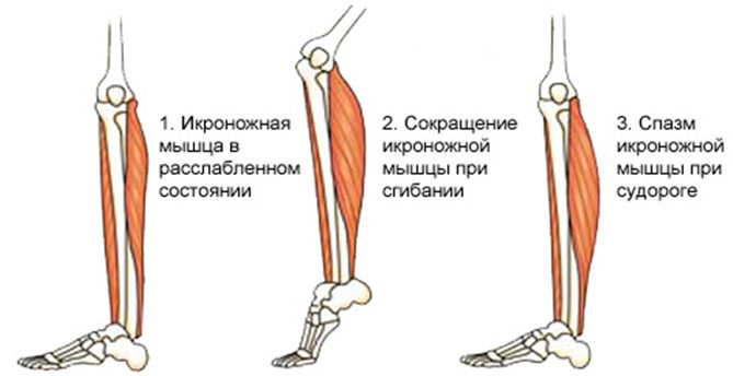 Cramps in the calf muscles: what to do?