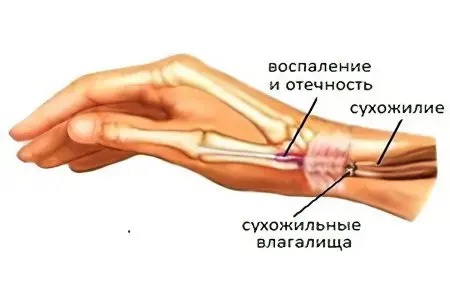 Crepitating tendovaginitis