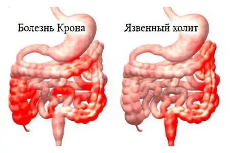 Crohn&#8217;s disease: what is it and how is it treated?