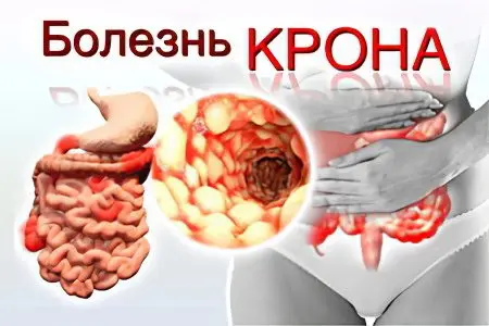 Crohns disease: what is it and how is it treated?