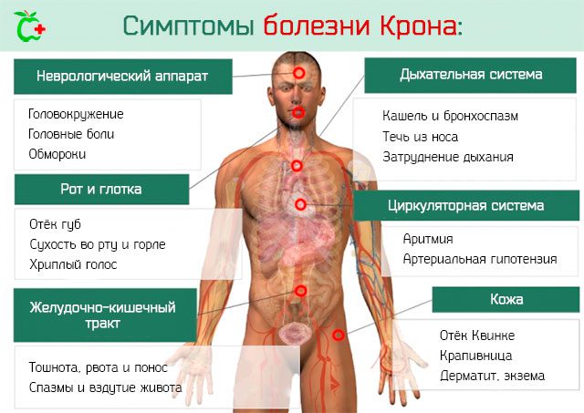 Crohns disease: what is it and how is it treated?