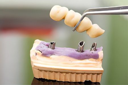 Crown on a tooth: what are they, how do they put it, does it hurt?