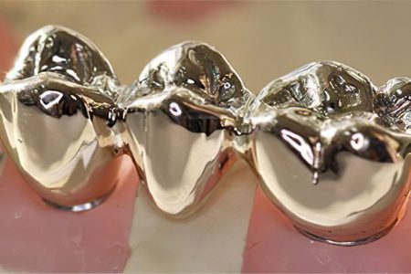 Crown on a tooth: what are they, how do they put it, does it hurt?