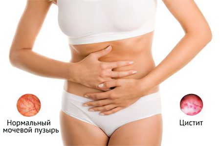 Cystitis in women: causes, symptoms, how to treat?