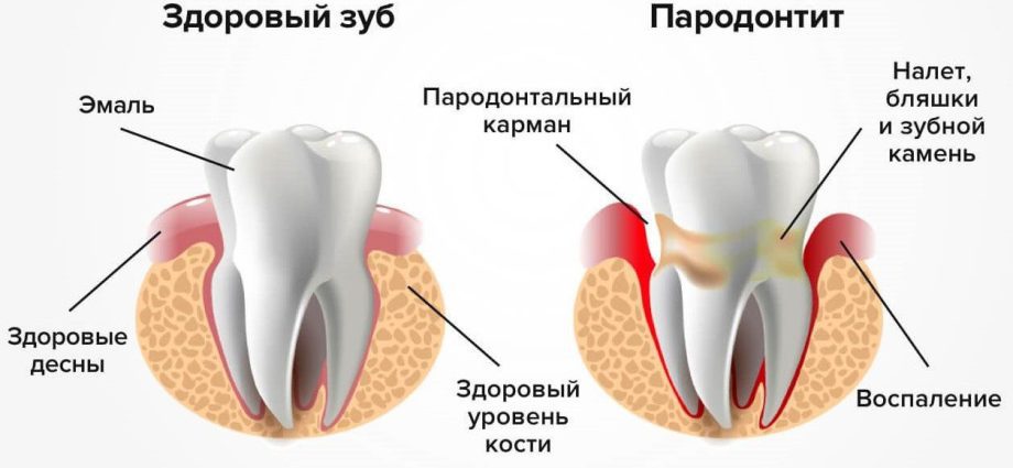 Degrees and symptoms of periodontitis