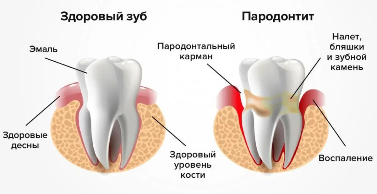 Degrees and symptoms of periodontitis