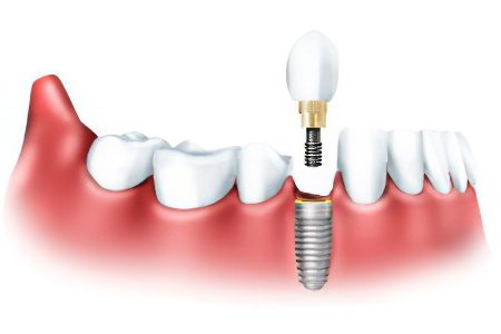 Degrees and symptoms of periodontitis