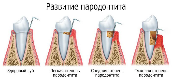 Degrees and symptoms of periodontitis