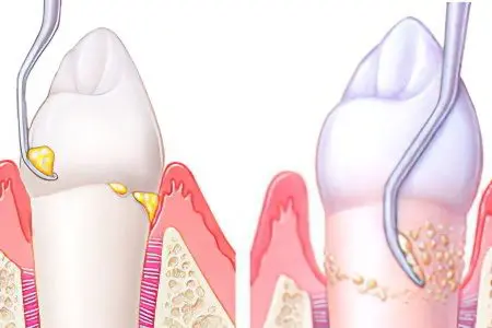 Degrees and symptoms of periodontitis