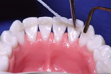 Degrees and symptoms of periodontitis