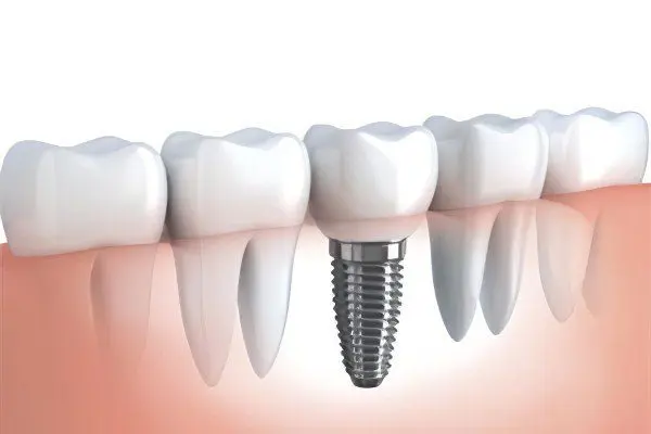 Dental implantation